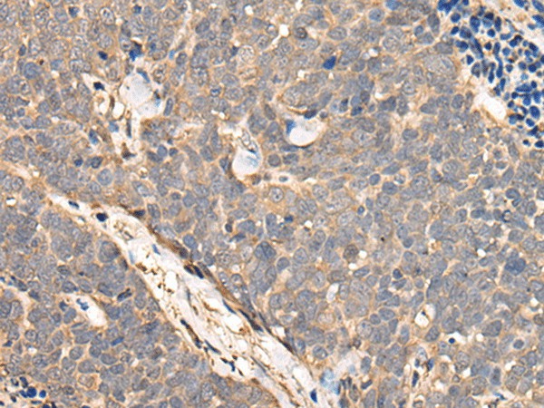 Immunohistochemistry of paraffin-embedded Human thyroid cancer tissue  using NCAPH Polyclonal Antibody at dilution of 1:45(?200)