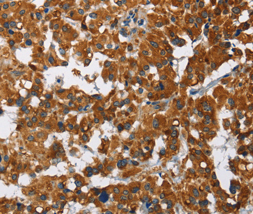 Immunohistochemistry of paraffin-embedded Human thyroid cancer using CAT Polyclonal Antibody at dilution of 1:40