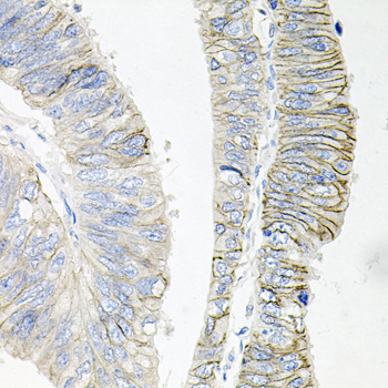 Immunohistochemistry of paraffin-embedded Human colon carcinoma using ATP1B1 Polyclonal Antibody at dilution of 1:100 (40x lens).