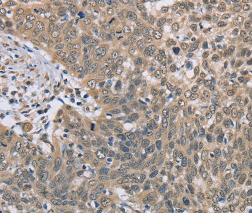 Immunohistochemistry of paraffin-embedded Human cervical cancer tissue using DACH2 Polyclonal Antibody at dilution 1:40