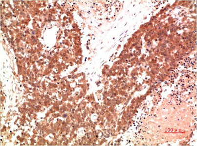 Immunohistochemistry of paraffin-embedded Human lung carcinoma tissue using AMPK alpha1 Monoclonal Antibody at dilution of 1:200.