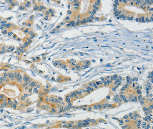 Immunohistochemistry of paraffin-embedded Human colon cancer using ASAH2 Polyclonal Antibody at dilution of 1:40