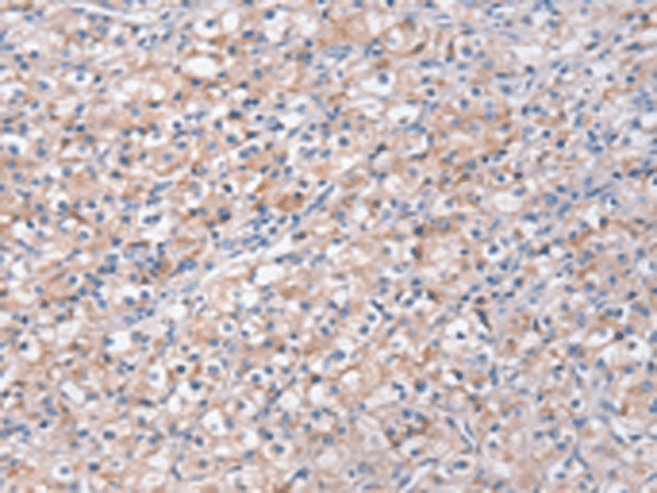 Immunohistochemistry of paraffin-embedded Human prost ate cancer tissue  using STK16 Polyclonal Antibody at dilution of 1:30(?200)