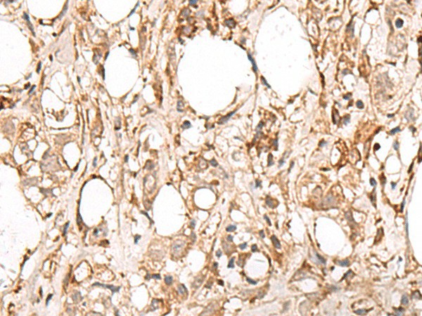 Immunohistochemistry of paraffin-embedded Human breast cancer tissue  using FBXW8 Polyclonal Antibody at dilution of 1:65(?200)