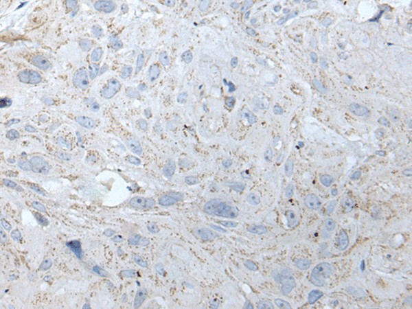 Immunohistochemistry of paraffin-embedded Human esophagus cancer tissue  using RASA1 Polyclonal Antibody at dilution of 1:40(?200)