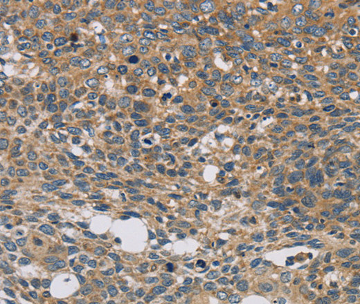 Immunohistochemistry of paraffin-embedded Human cervical cancer tissue using STAT4 Polyclonal Antibody at dilution 1:30