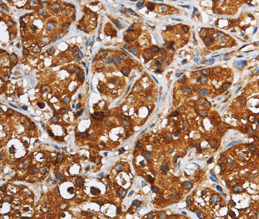 Immunohistochemistry of paraffin-embedded Human breast cancer tissue using GGCX Polyclonal Antibody at dilution 1:60