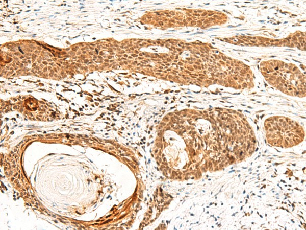 Immunohistochemistry of paraffin-embedded Human esophagus cancer tissue  using GTF3A Polyclonal Antibody at dilution of 1:60(?200)