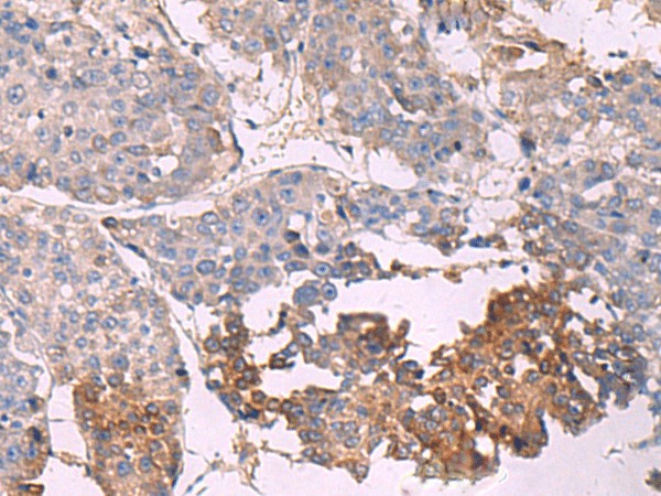 Immunohistochemistry of paraffin-embedded Human liver cancer tissue  using NIPSNAP1 Polyclonal Antibody at dilution of 1:35(?200)