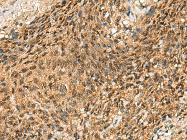 Immunohistochemistry of paraffin-embedded Human cervical cancer tissue  using CRCP Polyclonal Antibody at dilution of 1:65(?200)