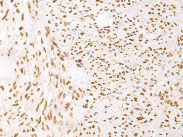 Immunohistochemistry of paraffin-embedded Human liver cancer tissue  using TCOF1 Polyclonal Antibody at dilution of 1:50(?200)