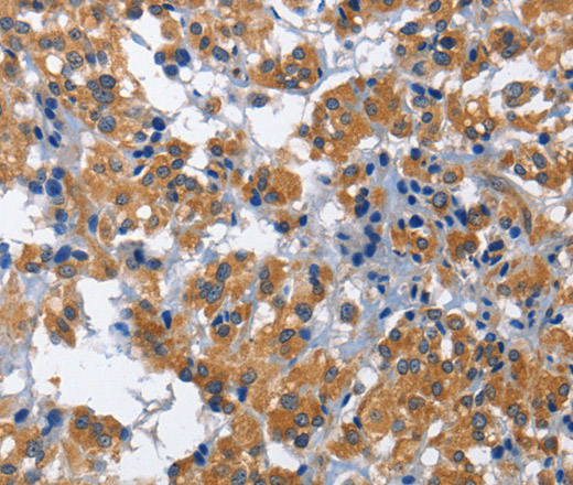 Immunohistochemistry of paraffin-embedded Human thyroid cancer using HSF27 Polyclonal Antibody at dilution of 1:60