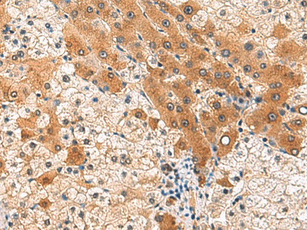 Immunohistochemistry of paraffin-embedded Human liver cancer tissue  using PCYT2 Polyclonal Antibody at dilution of 1:85(?200)