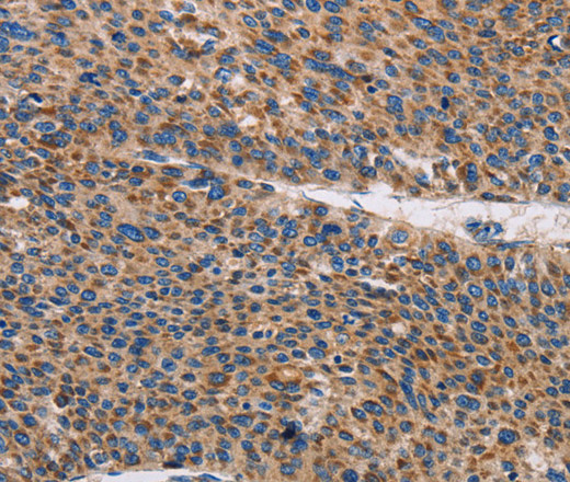 Immunohistochemistry of paraffin-embedded Human liver cancer tissue using TLR8 Polyclonal Antibody at dilution 1:30