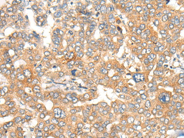 Immunohistochemistry of paraffin-embedded Human liver cancer tissue  using CASP4 Polyclonal Antibody at dilution of 1:40(?200)