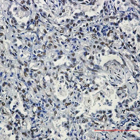 Immunohistochemistry of FTO in paraffin-embedded Human lung cancer tissue using FTO Rabbit mAb at dilution 1:50