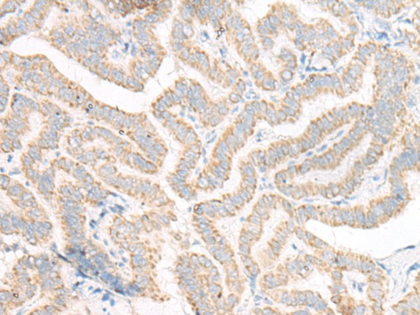 Immunohistochemistry of paraffin-embedded Human thyroid cancer tissue  using ACSF2 Polyclonal Antibody at dilution of 1:30(?200)