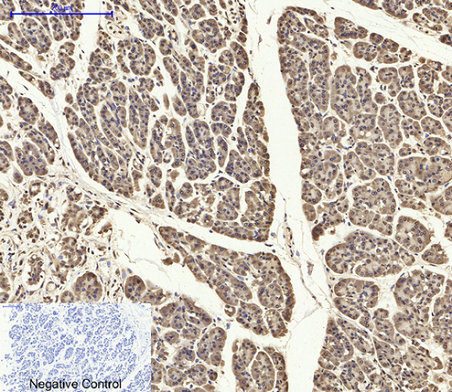 Immunohistochemistry of paraffin-embedded Human stomach cancer tissue using PYCARD Polyclonal Antibody at dilution of 1:200.