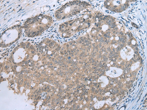 Immunohistochemistry of paraffin-embedded Human gastric cancer tissue  using CCNG1 Polyclonal Antibody at dilution of 1:30(?200)