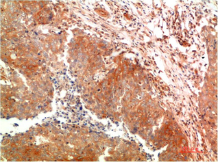 Immunohistochemistry of paraffin-embedded Human breast carcinoma tissue using ATG5 Monoclonal Antibody at dilution of 1:200.