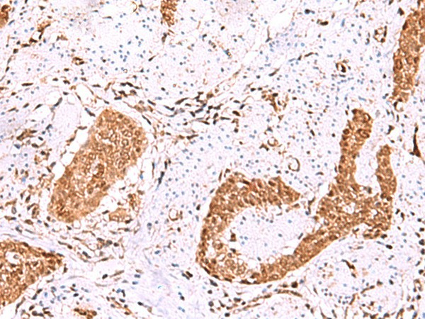 Immunohistochemistry of paraffin-embedded Human esophagus cancer tissue  using FDPS Polyclonal Antibody at dilution of 1:60(?200)