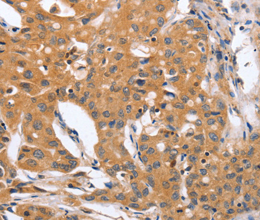 Immunohistochemistry of paraffin-embedded Human lung cancer tissue using BLNK Polyclonal Antibody at dilution 1:50