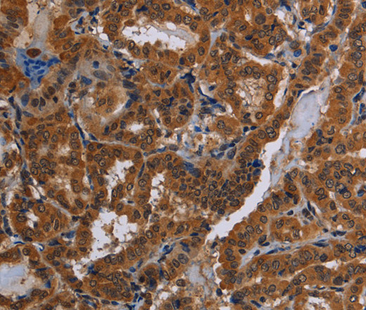 Immunohistochemistry of paraffin-embedded Human thyroid cancer tissue using CYBB Polyclonal Antibody at dilution 1:40