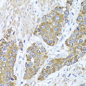 Immunohistochemistry of paraffin-embedded human prostate cancer using PEX14 Polyclonal Antibody at dilution of 1:100 (40x lens).Perform microwave antigen retrieval with 10 mM PBS buffer pH 7.2 before commencing with IHC staining protocol.