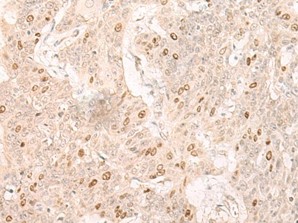 Immunohistochemistry of paraffin-embedded Human esophagus cancer tissue  using IL7 Polyclonal Antibody at dilution of 1:30(?200)