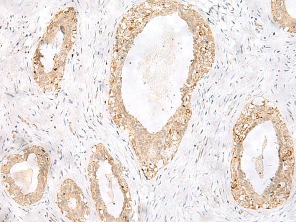 Immunohistochemistry of paraffin-embedded Human breast cancer tissue  using TOR1A Polyclonal Antibody at dilution of 1:35(?200)