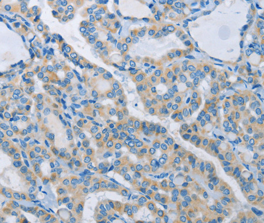 Immunohistochemistry of paraffin-embedded Human thyroid cancer tissue using NEK5 Polyclonal Antibody at dilution 1:60