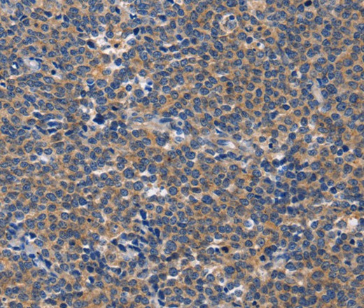 Immunohistochemistry of paraffin-embedded Human Lymphoma tissue using CD5L Polyclonal Antibody at dilution 1:40