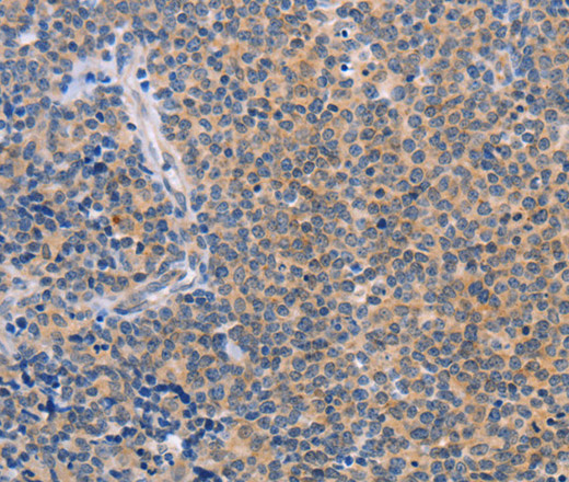 Immunohistochemistry of paraffin-embedded Human Lymphoma using CCL16  Polyclonal Antibody at dilution of 1:50