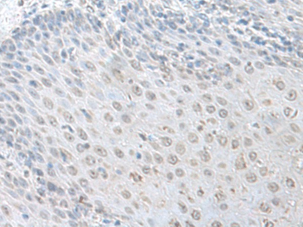 Immunohistochemistry of paraffin-embedded Human esophagus cancer tissue  using LSM10 Polyclonal Antibody at dilution of 1:100(?200)