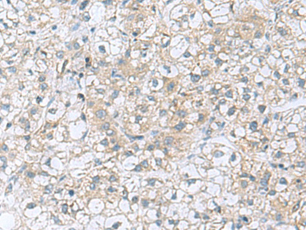 Immunohistochemistry of paraffin-embedded Human liver cancer tissue  using TRO Polyclonal Antibody at dilution of 1:80(?200)