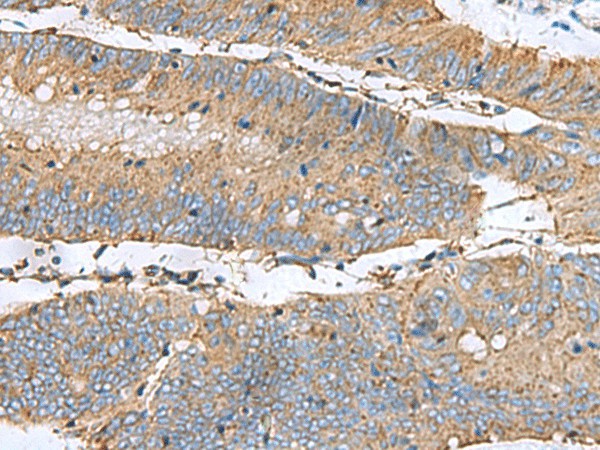 Immunohistochemistry of paraffin-embedded Human colorectal cancer tissue  using CLTB Polyclonal Antibody at dilution of 1:60(?200)