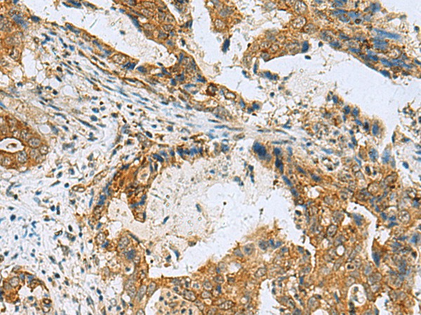 Immunohistochemistry of paraffin-embedded Human cervical cancer tissue  using TUBD1 Polyclonal Antibody at dilution of 1:70(?200)