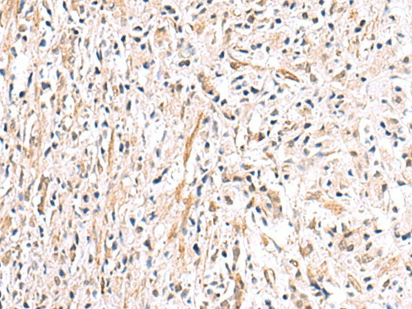 Immunohistochemistry of paraffin-embedded Human prost ate cancer tissue  using HLA-DOB Polyclonal Antibody at dilution of 1:40(?200)