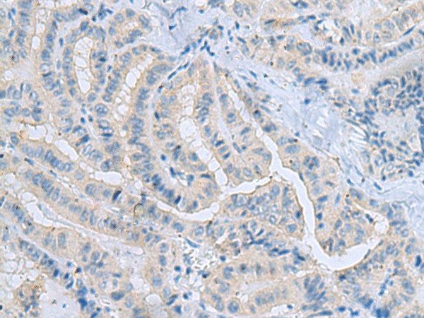 Immunohistochemistry of paraffin-embedded Human thyroid cancer tissue  using MSI2 Polyclonal Antibody at dilution of 1:70(?200)