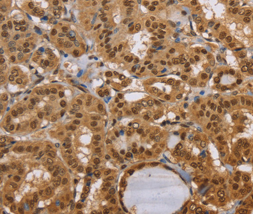 Immunohistochemistry of paraffin-embedded Human thyroid cancer using CEL Polyclonal Antibody at dilution of 1:40