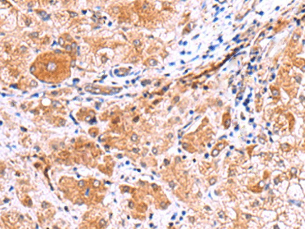 Immunohistochemistry of paraffin-embedded Human liver cancer tissue  using IRGC Polyclonal Antibody at dilution of 1:30(?200)