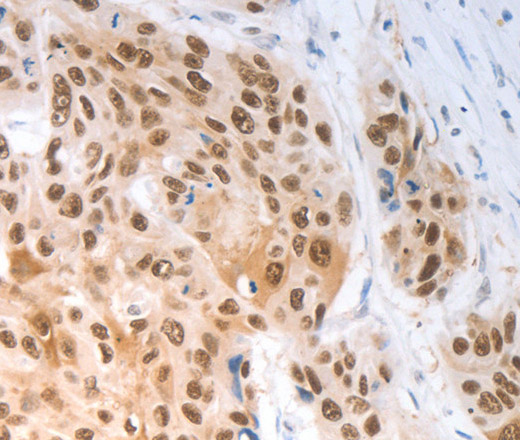 Immunohistochemistry of paraffin-embedded Human ovarian cancer tissue using SLC22A8 Polyclonal Antibody at dilution 1:70