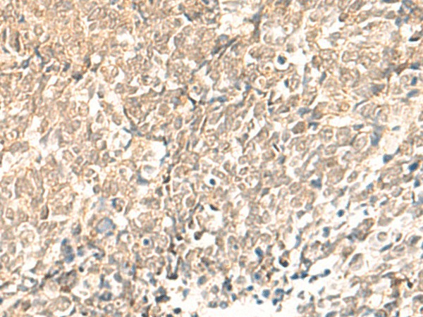 Immunohistochemistry of paraffin-embedded Human lung cancer tissue  using TBPL1 Polyclonal Antibody at dilution of 1:50(?200)