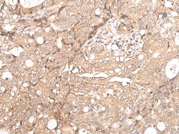 Immunohistochemistry of paraffin-embedded Human gastric cancer tissue  using FOXO4 Polyclonal Antibody at dilution of 1:70(?200)