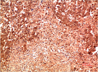 Immunohistochemistry of paraffin-embedded Human lung carcinoma  tissue using P38 Monoclonal Antibody at dilution of 1:200.