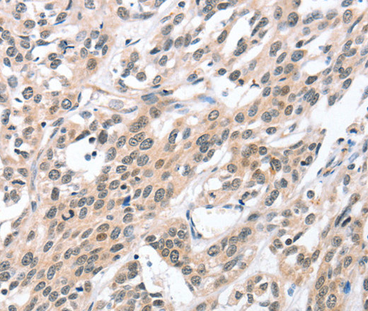 Immunohistochemistry of paraffin-embedded Human esophagus cancer tissue using HDAC8 Polyclonal Antibody at dilution 1:50