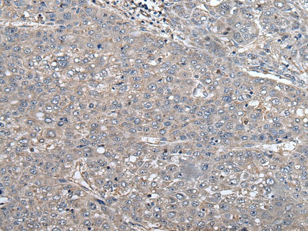 Immunohistochemistry of paraffin-embedded Human liver cancer tissue  using ARL1 Polyclonal Antibody at dilution of 1:50(?200)