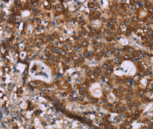 Immunohistochemistry of paraffin-embedded Human gastic cancer using GAD1 Polyclonal Antibody at dilution of 1:40