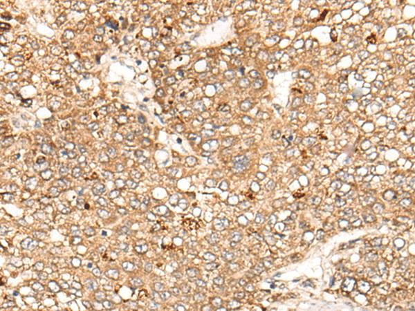 Immunohistochemistry of paraffin-embedded Human liver cancer tissue  using C1S Polyclonal Antibody at dilution of 1:55(?200)