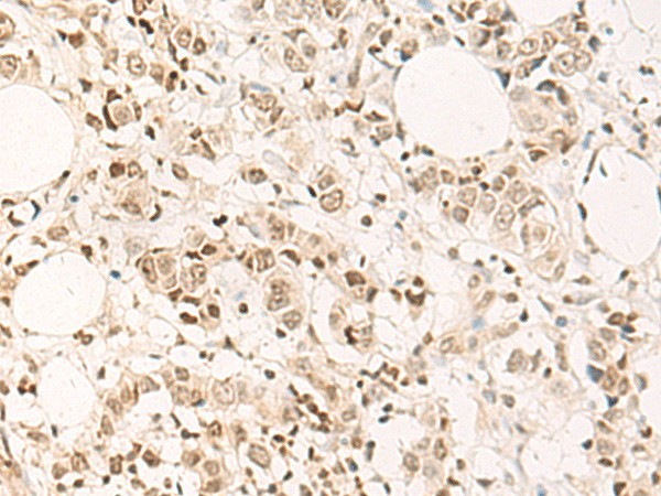 Immunohistochemistry of paraffin-embedded Human breast cancer tissue  using DPPA4 Polyclonal Antibody at dilution of 1:55(?200)